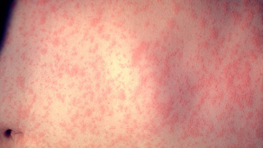 25 cases of measles identified in central, southeastern Minnesota, MDH says — WCCO / CBS Minnesota, Eagan Health news